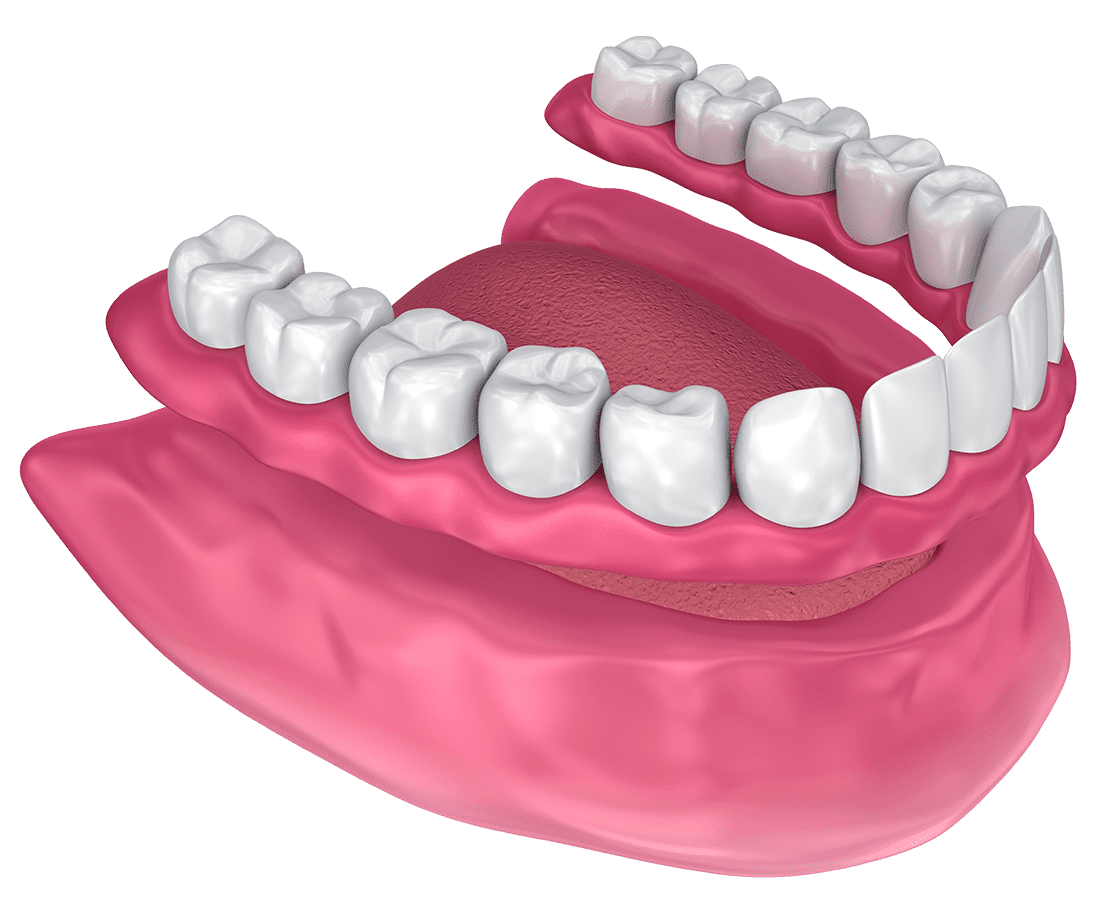 3D illustration of a lower jaw with gums, teeth, and tongue exposed. The lower dental arch is shown in place, while the upper dental arch is elevated above, demonstrating teeth alignment.