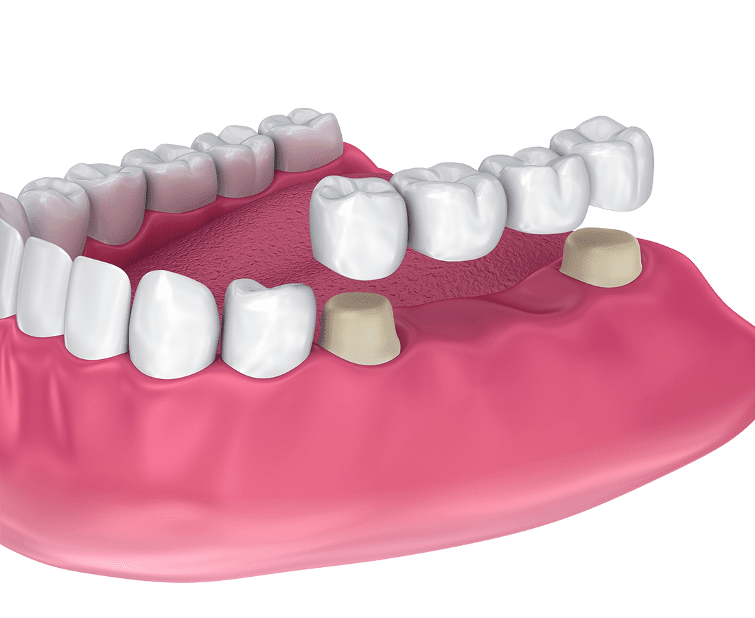 A dental bridge is shown being placed over two prepared teeth with a gap in the gum where teeth are missing. The bridge spans the gap, supported by crowns on the adjacent teeth.