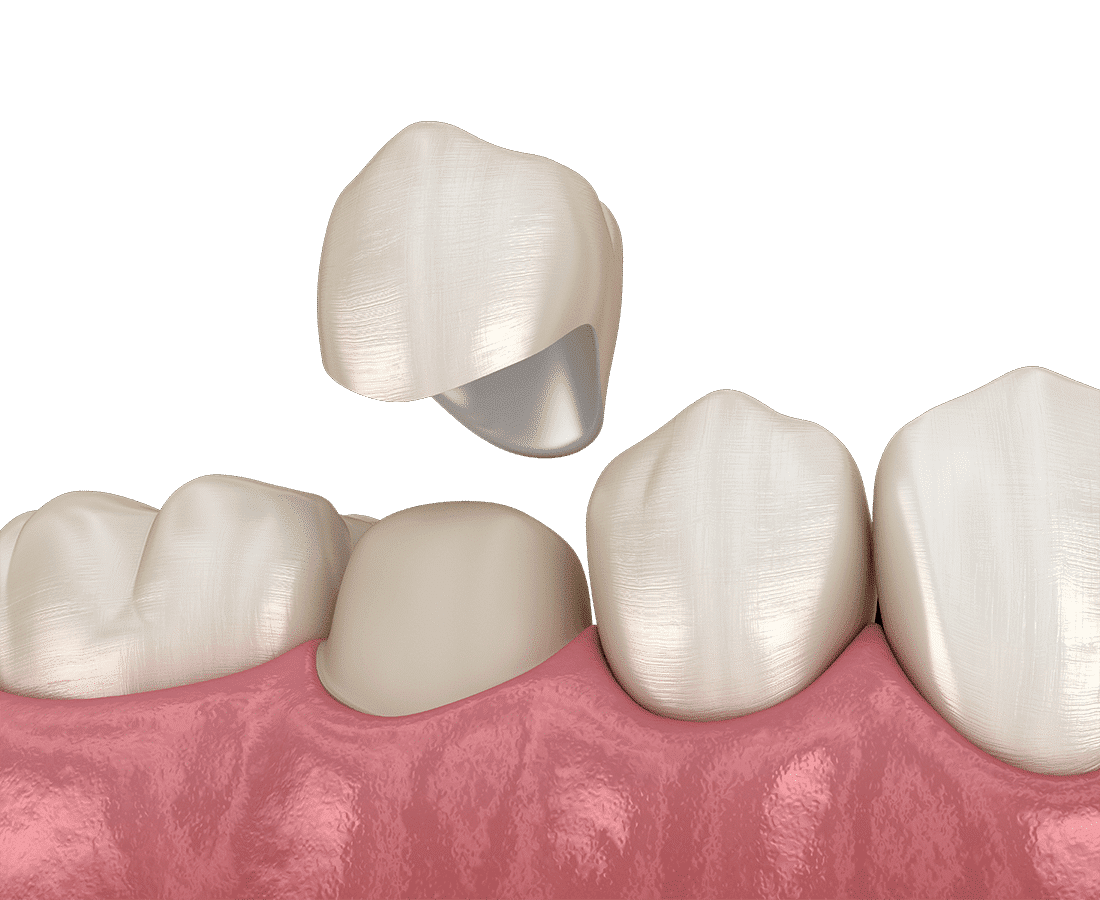 A dental crown being placed over a prepared tooth, shown in a realistic 3D illustration with gums and neighboring teeth visible.