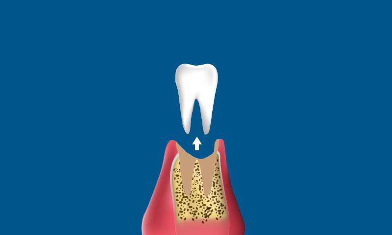 Illustration of a tooth being extracted from the gum, showing the root embedded in bone and an upward arrow indicating removal, on a blue background.