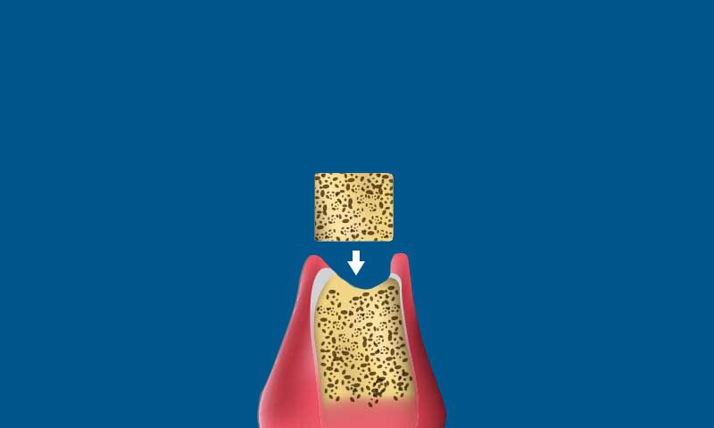 A dental illustration showing a section of jawbone and gum tissue with a square piece of bone graft material above it, indicated by a white downward arrow, suggesting bone graft placement.