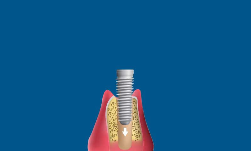 A dental implant is shown inserted into the jawbone, with gum tissue around it and an arrow indicating the direction of placement. The background is solid blue.