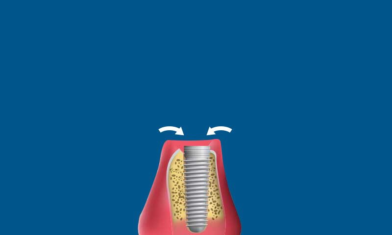Cross-section illustration of a dental implant in the jawbone and gum, with two white arrows above it, all set against a solid blue background.